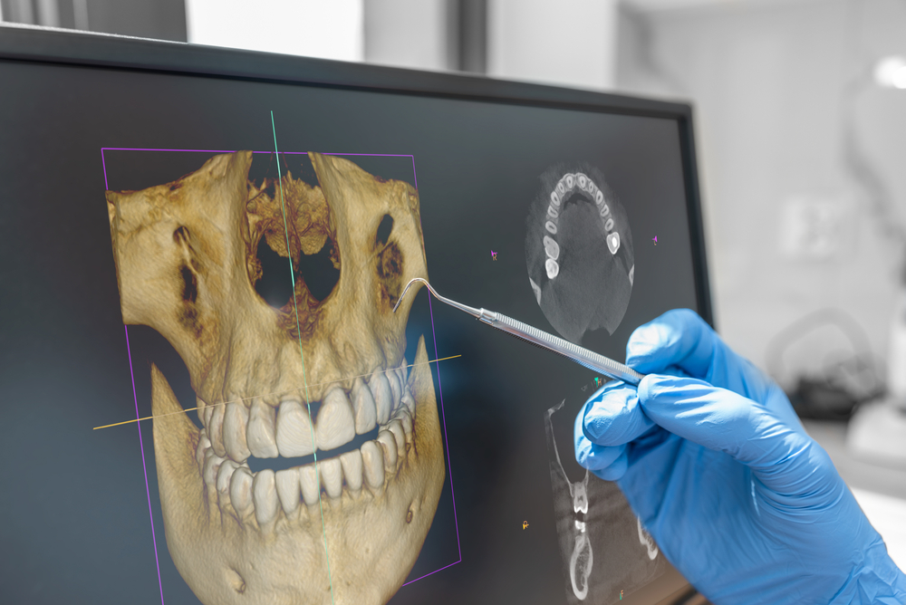 Scan 3D implants dentiste Valleyfield