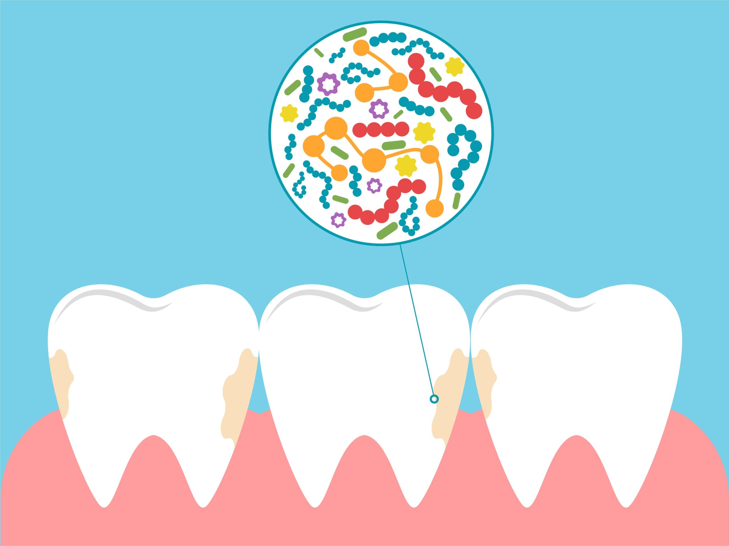 illustration de la plaque dentaire