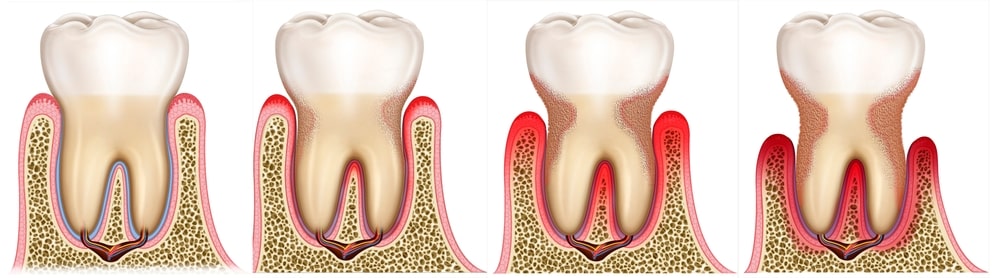 illustration de la parodontite
